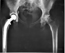 total hip replacement surgery baltimore