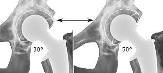 total hip replacement baltimore md.jpeg