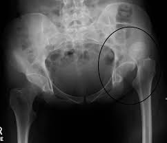total hip replacement baltimore md.jpg
